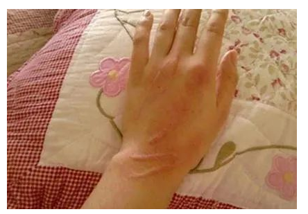 撸猫小心！被宠物猫抓了一下 竟得了这样的罕见病(图1)