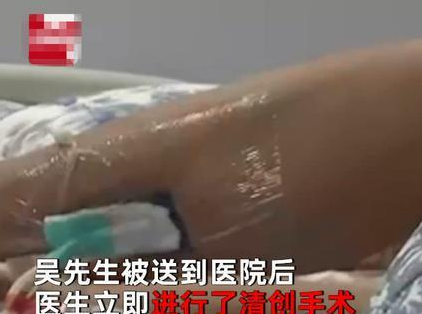 小猫偷嘴东西 男子打它再看看反被咬 小腿病菌感染肿得像气球(图3)