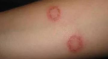 猫癣是会传染给人的,如何预防人感染上猫癣?三招完美预防猫癣传染(图2)