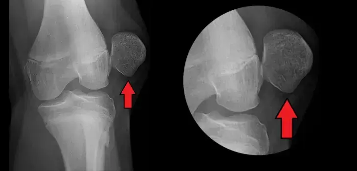 狗狗为什么会发生髌骨脱位?狗狗髌骨脱位如何治疗?(图2)