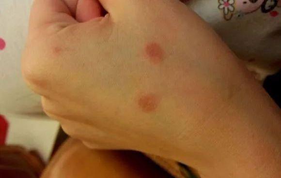 人感染猫癣怎么办?如何判断是否患有猫癣?消灭猫癣不得不知的方法(图1)