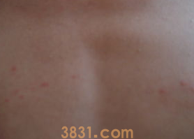 狗跳蚤跑到人身上怎么办?(图1)